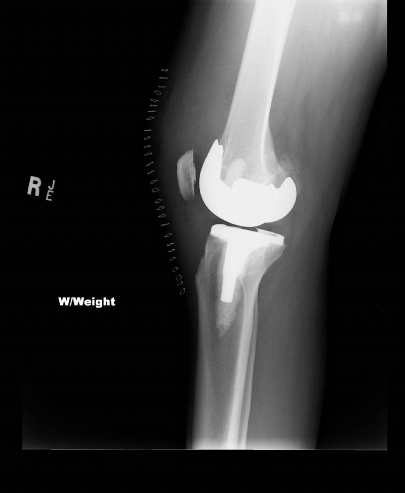 Smith & Nephew Journey Bi-Cruciate (Implant 4224)